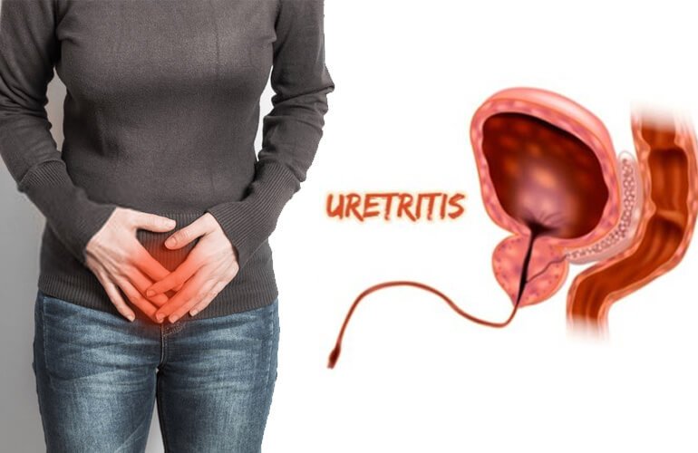 প্রস্রাবে জ্বালাপোড়া