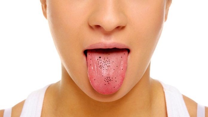 জিহ্বায় কালো দাগ হয় কেন জিহ্বা