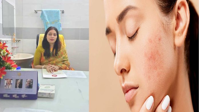 মুখে ব্রণ ওঠে কেন মুখে ব্রণ ওঠার কারণ