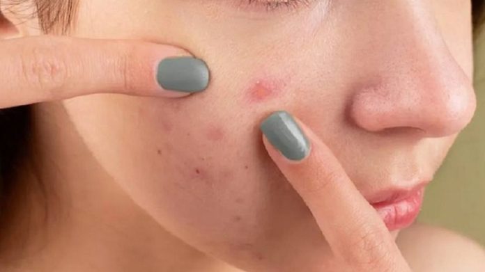 ত্বকে ফোঁড়া হলে কী করবেন ত্বকে ফোঁড়া