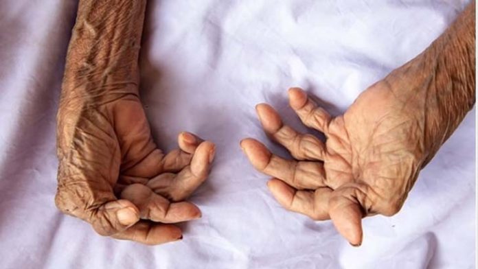 আর্থ্রাইটিসে আক্রান্ত আর্থ্রাইটিসে আক্রান্ত