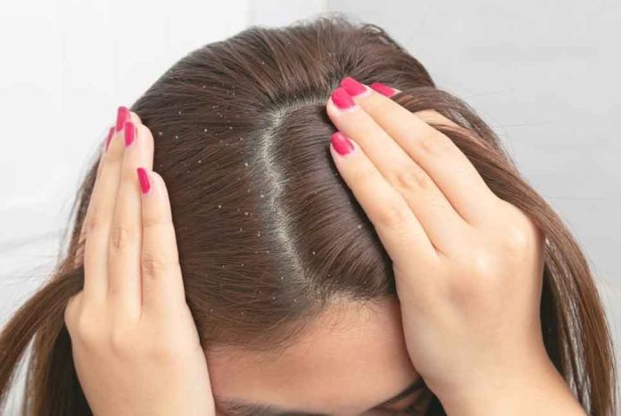 খুশকির চিকিৎসায় লবণ খুশকি