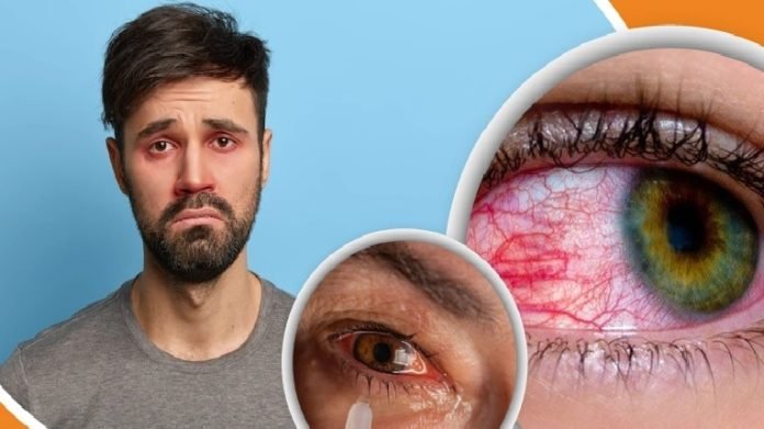 চোখ উঠলে কী করবেন চোখ ওঠা