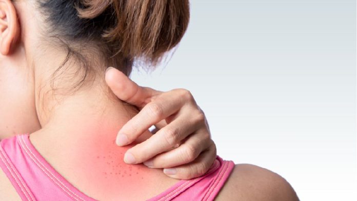 পাঁচ উপায়ে দূর করুন ঘামাচি ঘামাচি