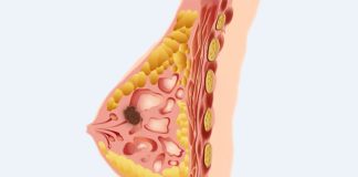 স্তন ক্যানসার স্ক্রিনিং কী, গুরুত্ব ও প্রয়োজনীয়তা স্তন ক্যানসার