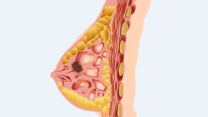 স্তন ক্যানসার