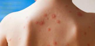 চিকেন পক্স হলে কি গোসল করা যাবে?