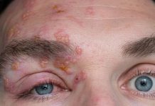 শিঙ্গলস হলে কী হয়? এই রোগের উপসর্গ কী?