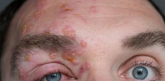 শিঙ্গলস হলে কী হয়? এই রোগের উপসর্গ কী?