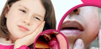 শীতে মাম্পস রোগের ঘরোয়া চিকিৎসা