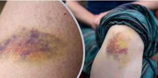 সামান্য আঘাতেই শরীরে কালশিটে দাগ, কীসের লক্ষণ?