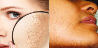 মুখে বেশি লোম, কোন জটিল রোগের লক্ষণ?