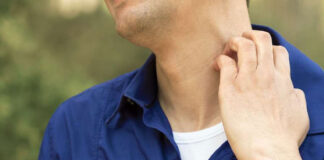 ঘামাচির সমস্যার ঘরোয়া সমাধান