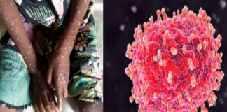 এমপক্সের ভয়াবহতা ও মৃত্যুহার