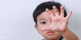 ‘বাটারফ্লাই স্কিন’ রোগে আক্রান্ত শিশুরা, লক্ষণগুলো কী কী?