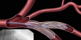 হার্টের রিংয়ের দাম কমলো