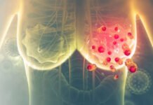 ব্রেস্ট ক্যানসার: জানুন কোন স্টেজে কী হয়