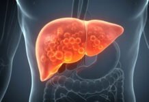 ফ্যাটি লিভার কেন হয়? দেখুন প্রতিরোধের সহজ উপায়