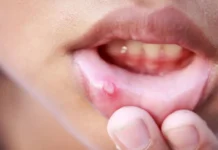 প্রাথমিক পর্যায়ে মুখের ক্যানসারের লক্ষণ জেনে নিন