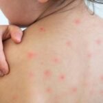 একনজরে দেখে নিন হামের চিকিৎসা ও করণীয়