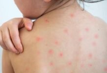 কীভাবে হাম প্রতিরোধ করা যায়?