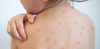 একনজরে দেখে নিন হামের চিকিৎসা ও করণীয়