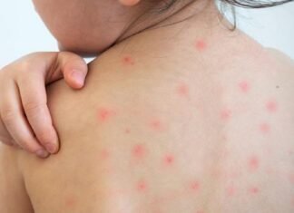 একনজরে দেখে নিন হামের চিকিৎসা ও করণীয়